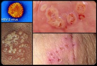 Illustration for article titled cara menghilangkan nyeri akibat herpes